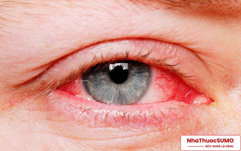 Một số bệnh về mắt có thể được hỗ trợ điều trị bởi thuốc