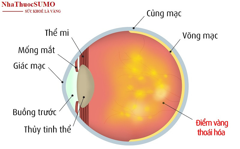 Thoái hóa điểm vàng cũng là một trong những bệnh mắt phổ biến