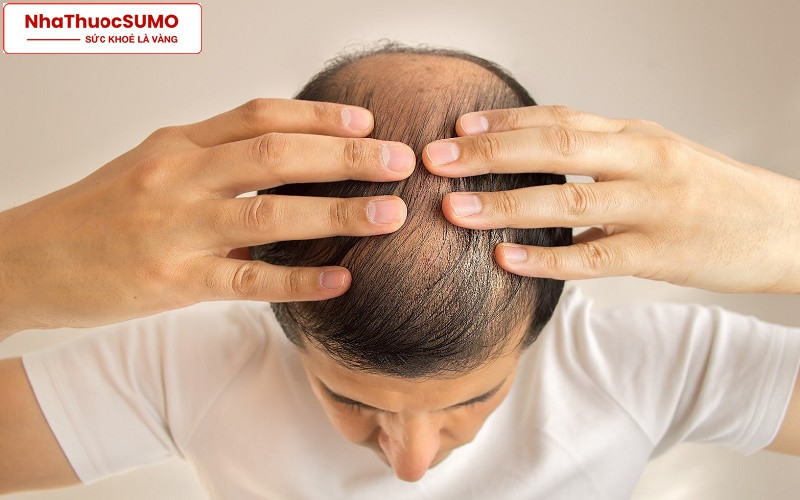 Tóc rụng nhiều bất thường cũng có thể là biểu hiện của testosterone