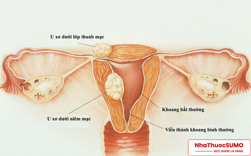 Với phụ nữ bị u xơ cổ tử cung thì dùng Crila có thể được điều trị