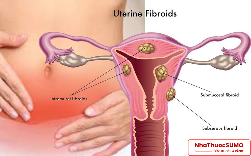 U xơ tử cung là căn bệnh thường gặp và có thể được điều trị bởi Crila Forte