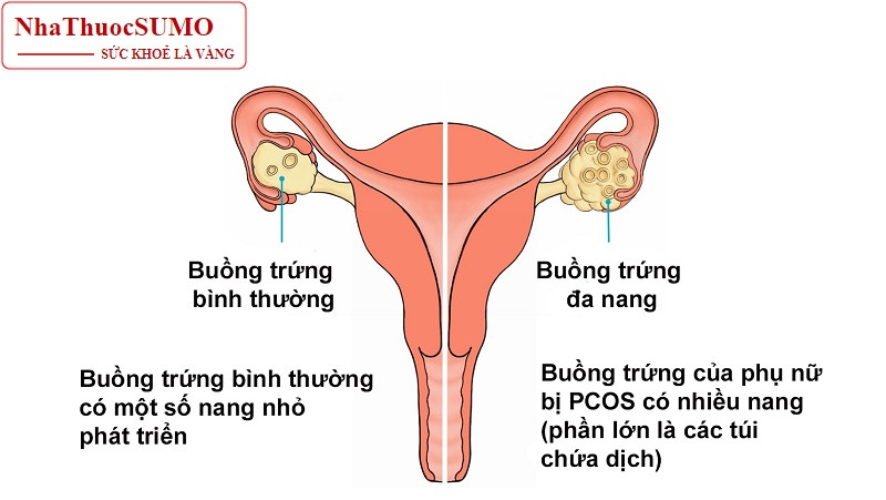 Minh họa rõ nét nhất để so sánh buồng trứng bình thường và đa nang buồng trứng