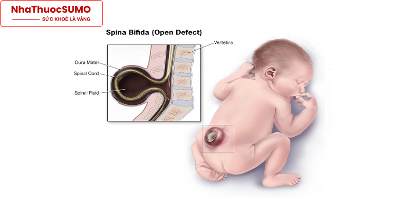 Dị tật ống thần kinh Spina Bifida dễ gây ra bệnh Down hoặc Edward