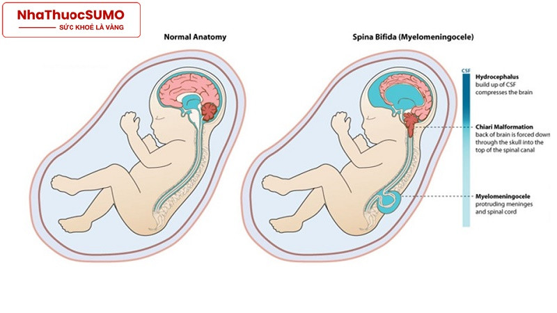 Trẻ sơ sinh thường bị dị tật ống thần kinh nếu trong thai kì không đảm bảo đủ dinh dưỡng