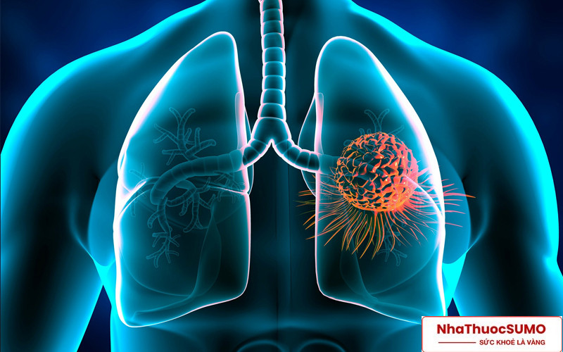 Nếu sử dụng thường xuyên Boni Detox sẽ giúp bảo vệ phổi trước nguy cơ bị ung thư