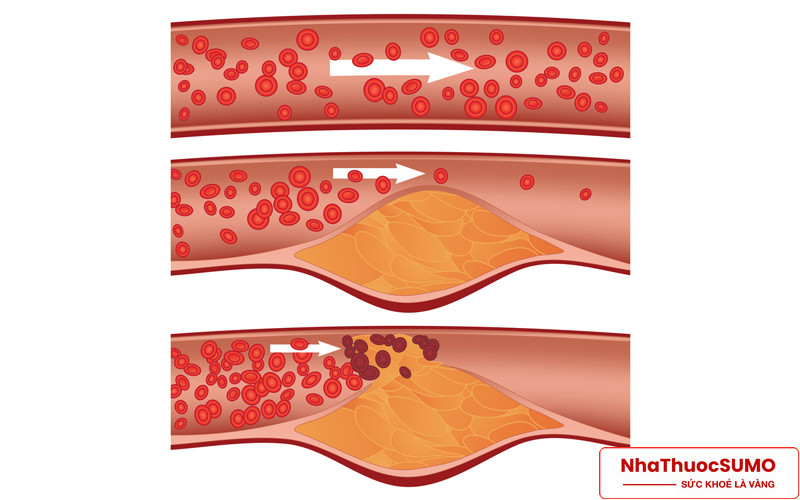 Cholesterol cao trong máu sẽ dẫn tới hẹp động mạch, gây nhiều bệnh nguy hiểm