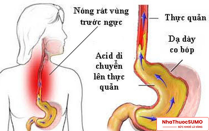 Nếu thường xuyên bị trào ngược dạ dày có thể sử dụng Nexium mups để hỗ trợ điều trị
