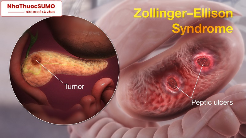 Hội chứng Zollinger - Ellison là một loại bệnh về dạ dày cũng có thể được điều trị