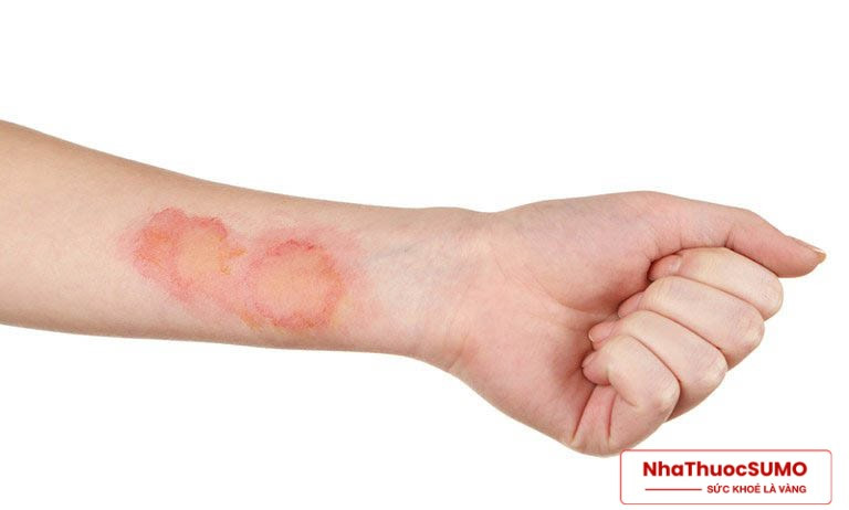 Các loại nhiễm trùng thông thường trên da cũng sẽ sử dụng thuốc để cải thiện