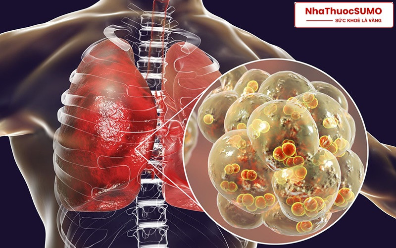 Thuốc Rovamycine 3miu hỗ trợ điều trị các bệnh liên quan đến phổi, hô hấp