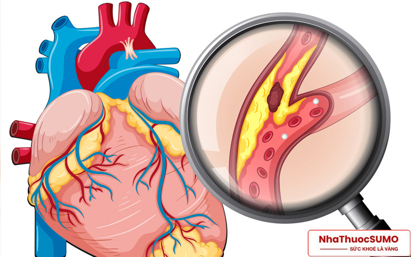 Sử dụng Cardioton sẽ không còn phải lo bệnh xơ vữa động mạch