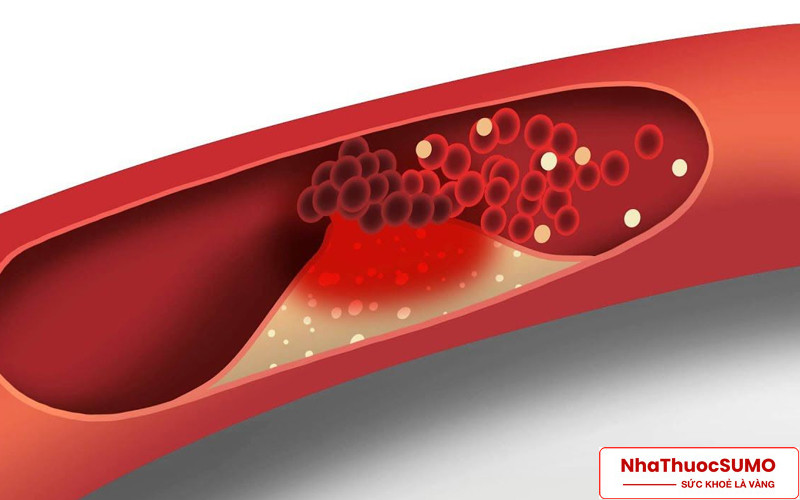 Cholesterol giảm sẽ giúp ngăn ngừa mắc gan nhiễm mỡ, máu nhiễm mỡ