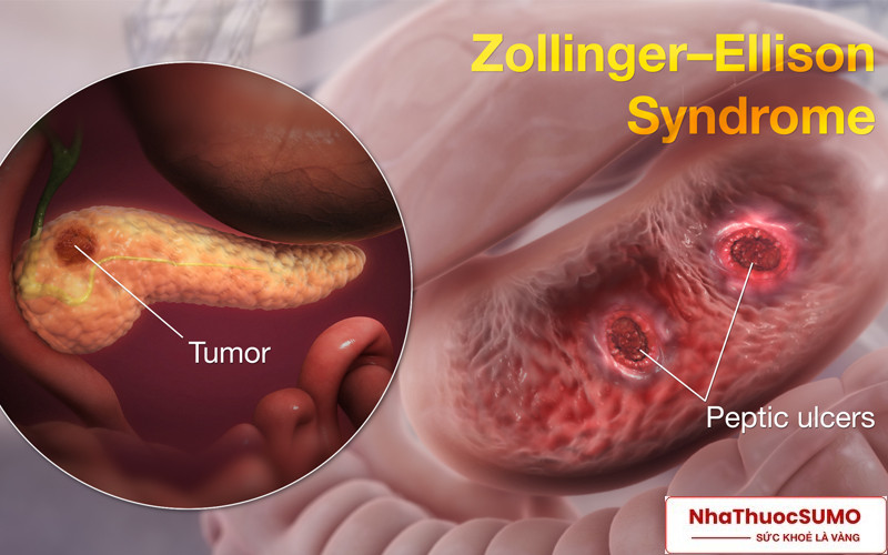 Hội chứng Zollinger-Ellison thường gặp cũng sẽ được loại bỏ