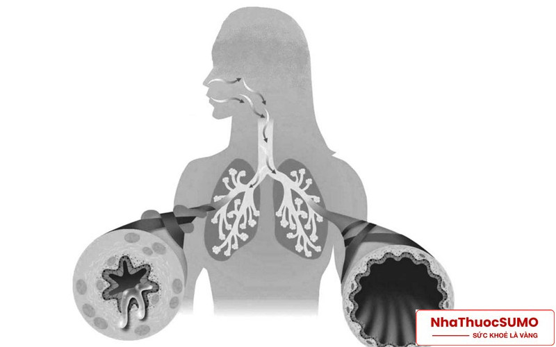 Giảm tắc nghẽn phổi mãn tính là một trong những công dụng nổi bật của Seretide