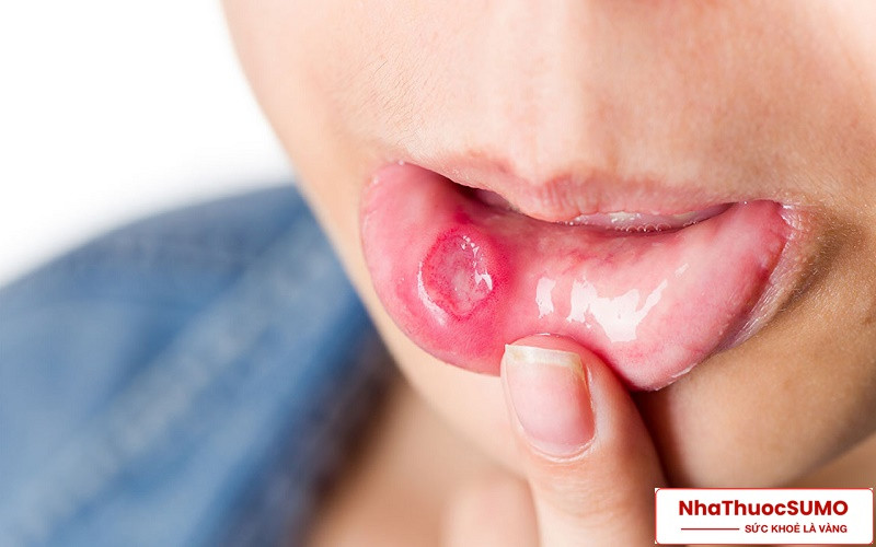 Một trong những dấu hiệu của thiếu kẽm là dễ bị nhiệt miệng, viêm răng lợi